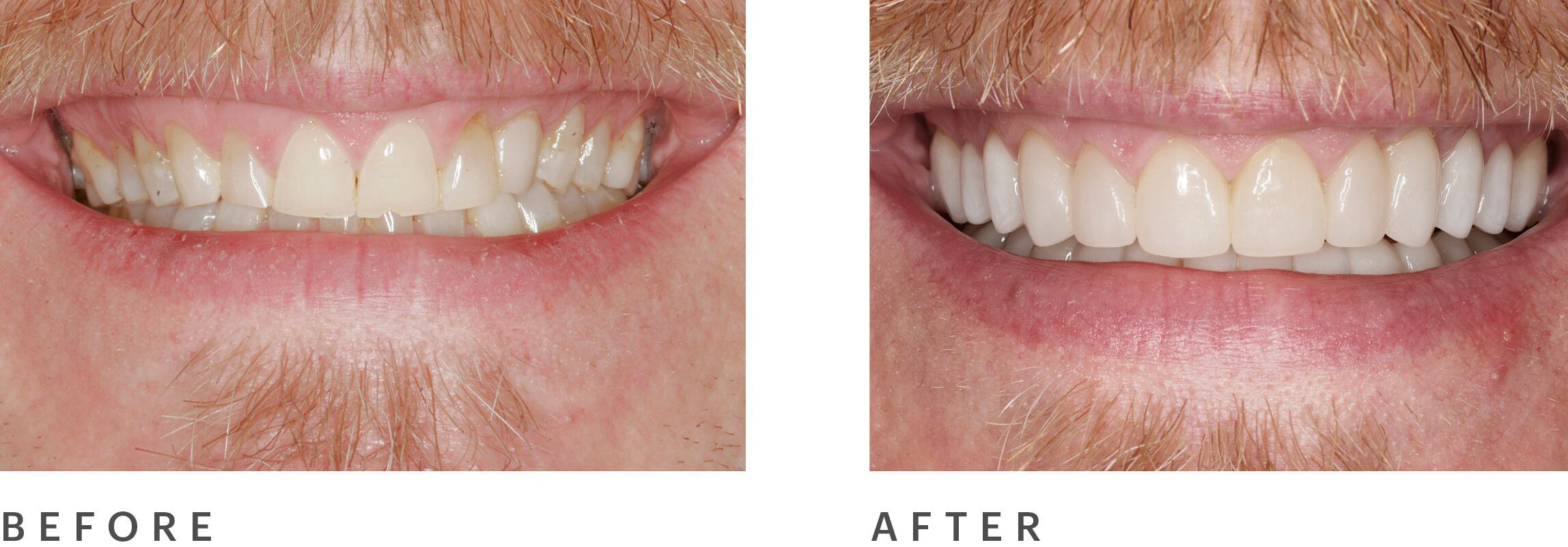 before and after gum lift