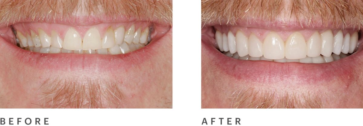 before and after gum lift