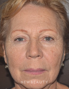 Dr. Roman Rayham - Laser Skin Resurfacing - Before