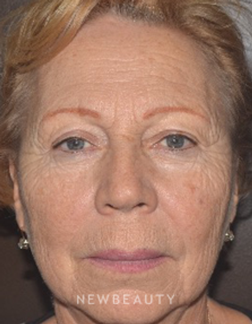 Dr. Roman Rayham - Laser Skin Resurfacing - Before