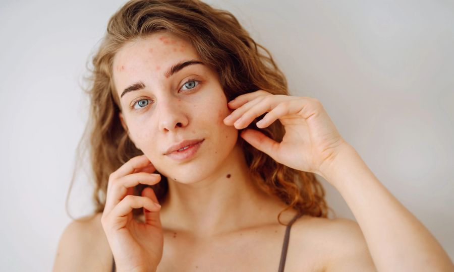 perioral dermatitis