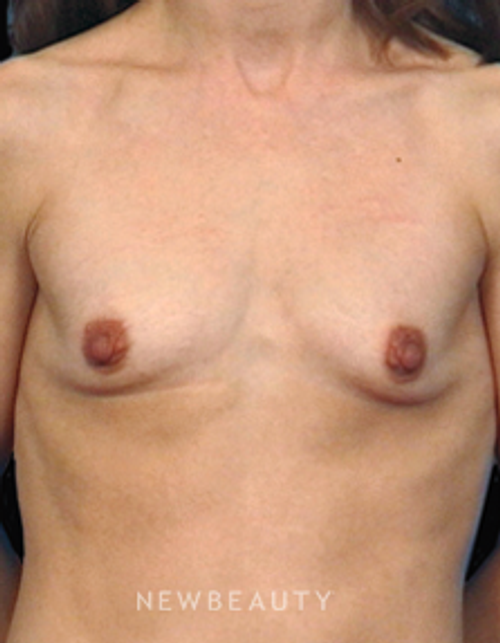 Dr. Bradley Bengtson - Shaping the Breast - Before