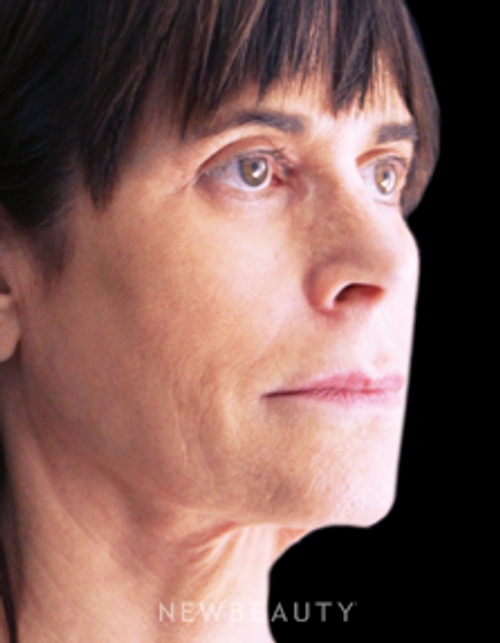 Dr. Joseph A. Russo - FaceTite - Before