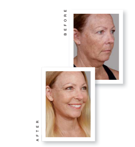 woman before and after plastic surgery