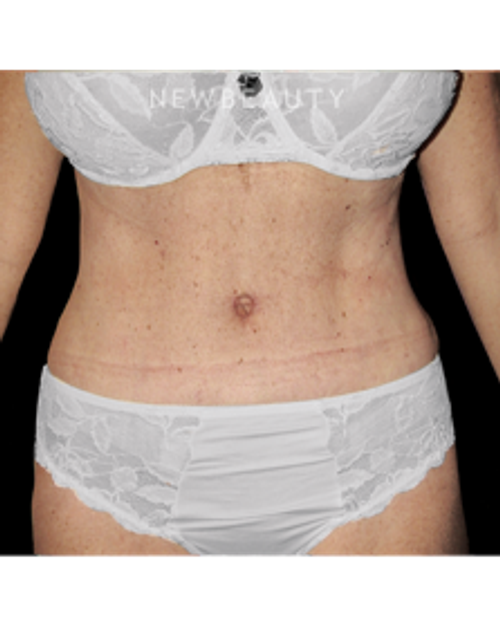 Dr. Bryan W. Gawley - Fit and Trim Results - After