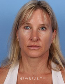 Dr. Kelly Bomer - Anti-Aging - After