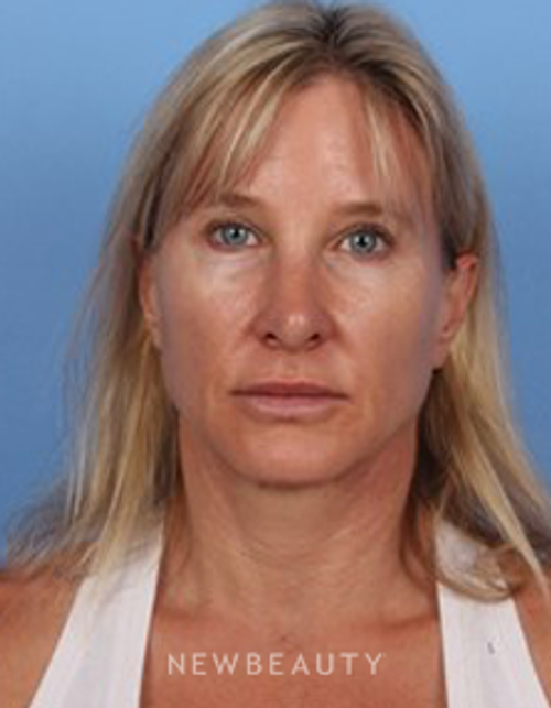 Dr. Kelly Bomer - Anti-Aging - After