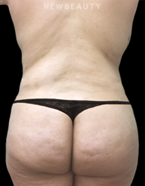 Dr. Kirk Churukian - VASER Lipo - After