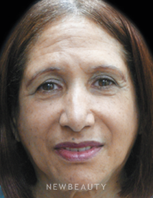 Dr. Jody Levine Injectables and Fillers - After