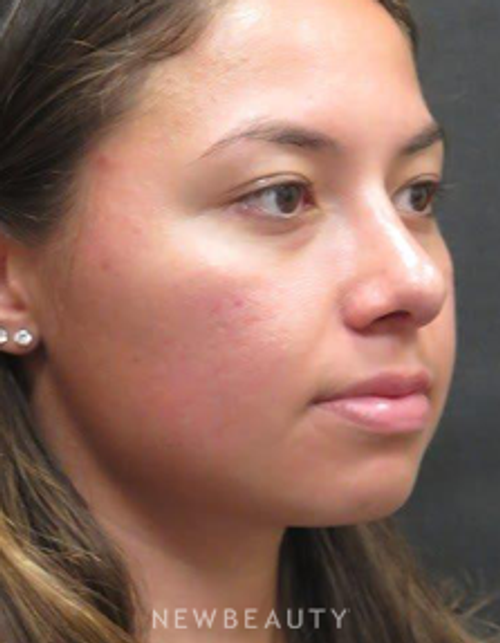 Dr. Elie Levine - Rhinoplasty - After