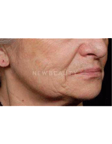 Dr. Ruth Hillelson Thermage - Before