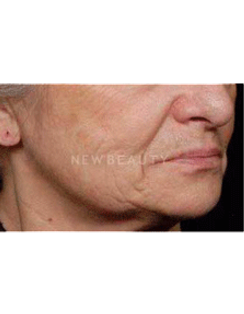 Dr. Ruth Hillelson Thermage - Before