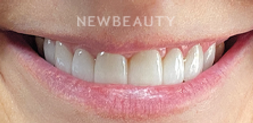 Dr. Sonya L. Wintzell - Vibrant Smile Design - 33124538 - After