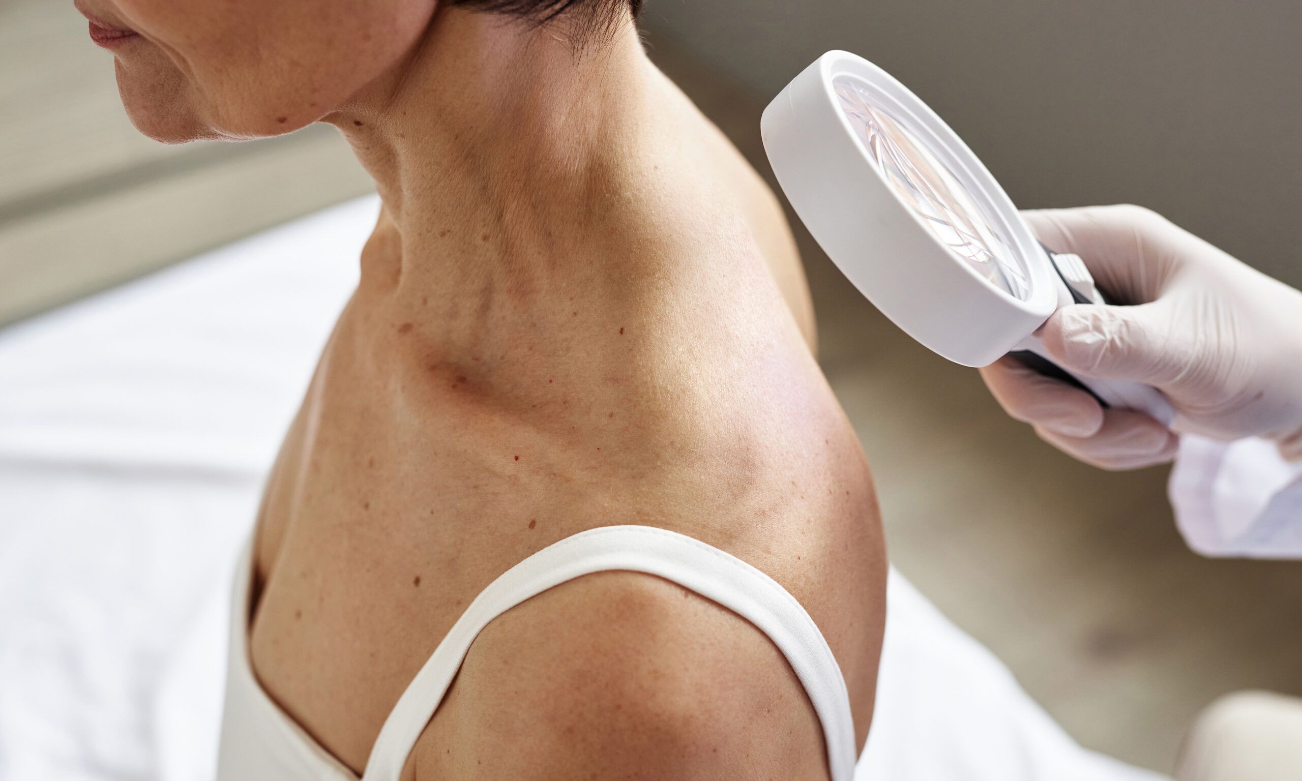 la roche posay melanoma monday skin checks