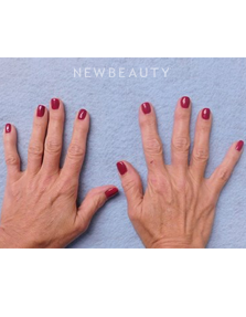 Dr. Kenneth Beer- Injectables and Fillers - Before