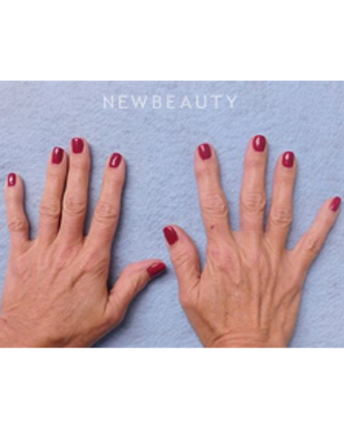 Dr. Kenneth Beer- Injectables and Fillers - Before