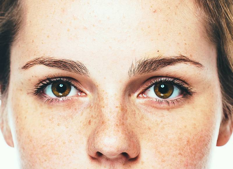 hyperpigmentation