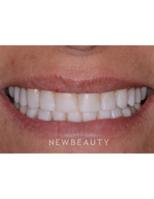 Dr. Irene Grafman - Smile Makeover - After