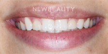 Dr. Nathan Hoffman - Teeth Whitening & Veneers - Before