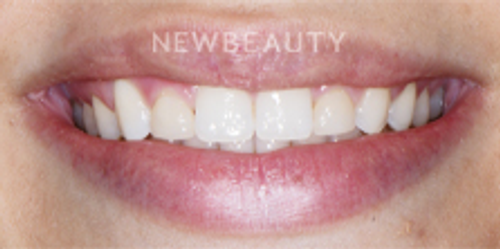 Dr. Nathan Hoffman - Teeth Whitening & Veneers - Before