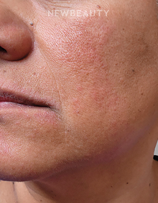 Dr. Anna Chacon - Melasma - 34291235 - Before