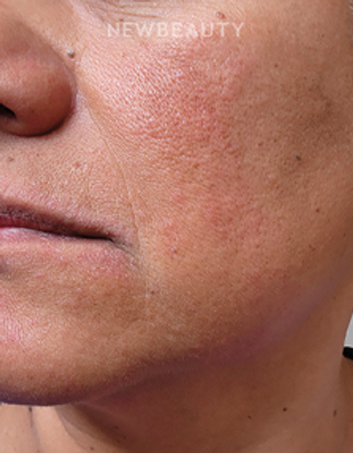 Dr. Anna Chacon - Melasma - 34291235 - Before