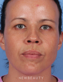 Dr. Kelly Bomer - Injectables & Fillers - After