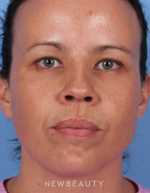 Dr. Kelly Bomer - Injectables & Fillers - After