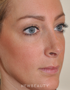 Dr. Edward S. Kwak - Revision Rhinoplasty - Before