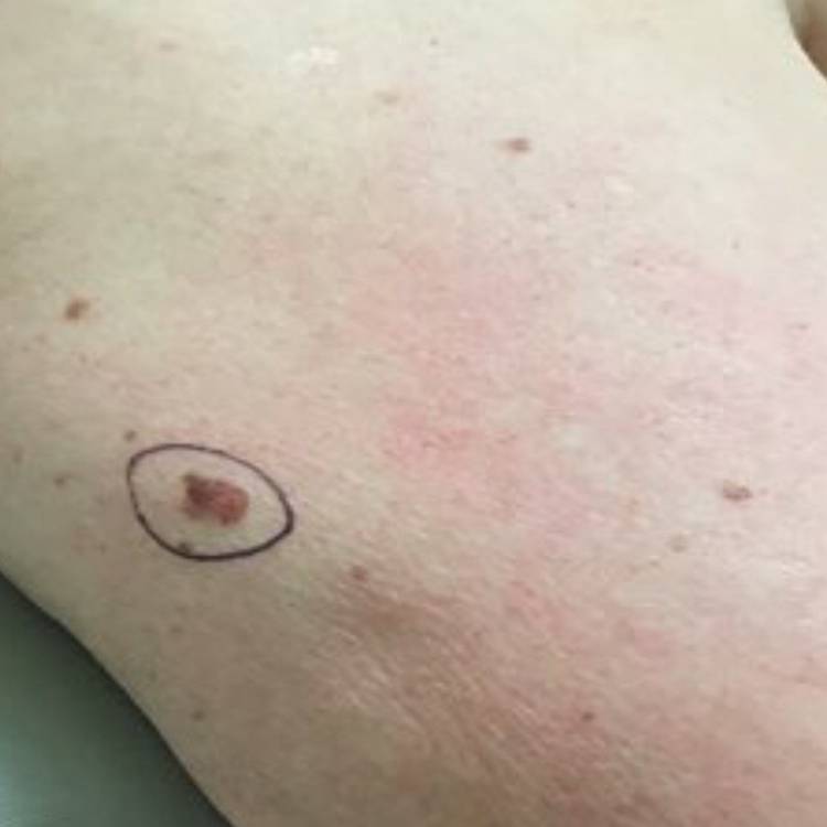 skin cancer on body