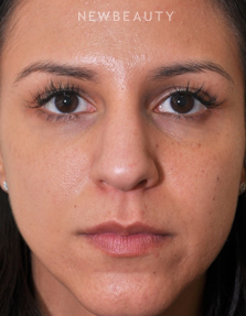 Dr. Edward Kwak - Rhinoplasty - Before