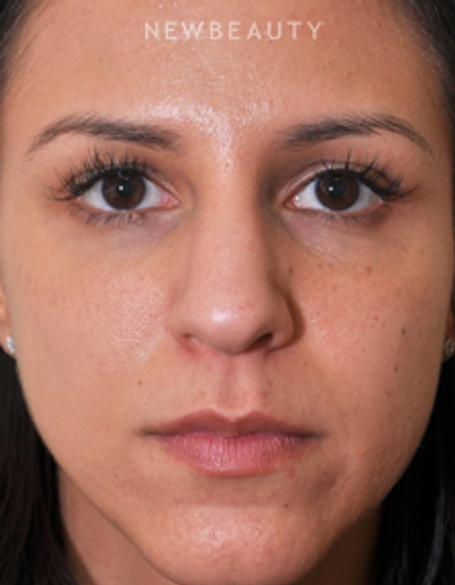 Dr. Edward Kwak - Rhinoplasty - Before