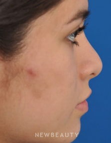 Dr. Edward Kwak - Revision Rhinoplasty - Before