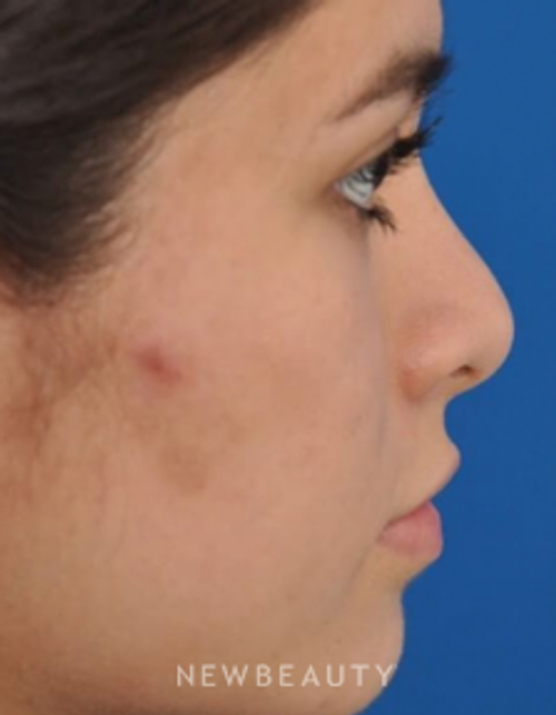 Dr. Edward Kwak - Revision Rhinoplasty - Before