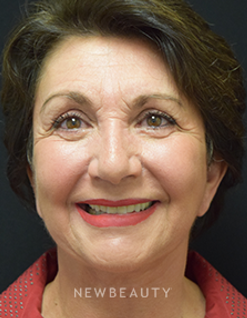 Dr. Jeffrey B. Wise - Eyelift, Facelift & Lasers - After