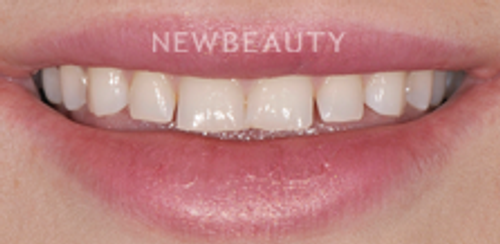 Dr. Salvator La Mastra – Smile Makeover – 46107128 - Before