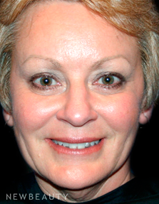 Dr. Kelly Bomer Liquid Facelift - After