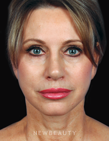 Dr. Kelly Bomer - Facelift - After