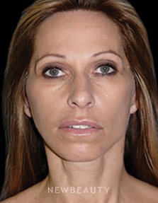 Ordon & Chopra - Facial Rejuvenation - After