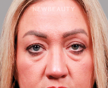 Dr. Peter Vonu-Blepharoplasty-44687802 - Before