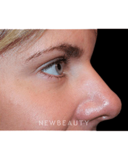Dr. Marina Peredo Botox - After