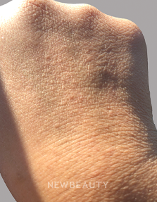 Dr. Anna Chacon - Eczema - 34284272 - Before