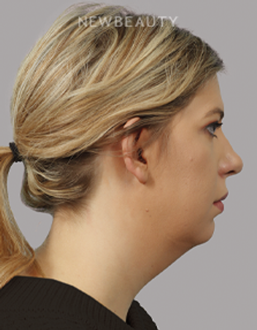 Dr. Michael McNeel - Profile Refinement - 44726153 - Before