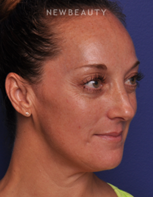 Dr. Alan J. Durkin - Injectables and Fillers - After