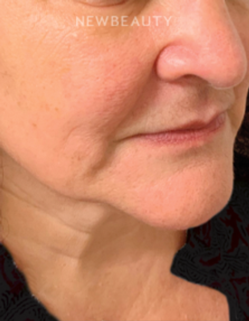 Dr. Doris Day - Facial Rejuvenation - Before