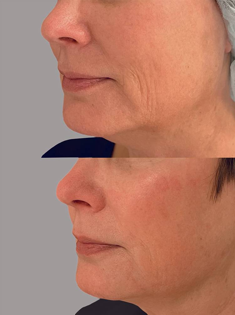 Skin Firming