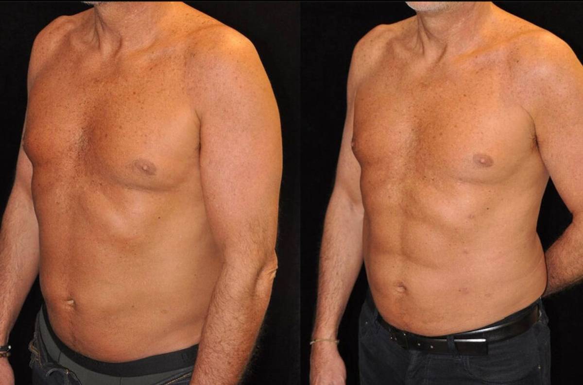 emsculpt-terner