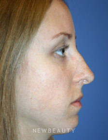 Dr. Kelly Bomer, Chin Augmentation, Rhinoplasty - Before