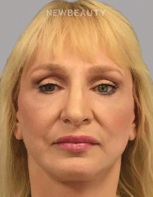 DR. AMY M. SPROLE - Facial Rejuvenation - 46920209 - After