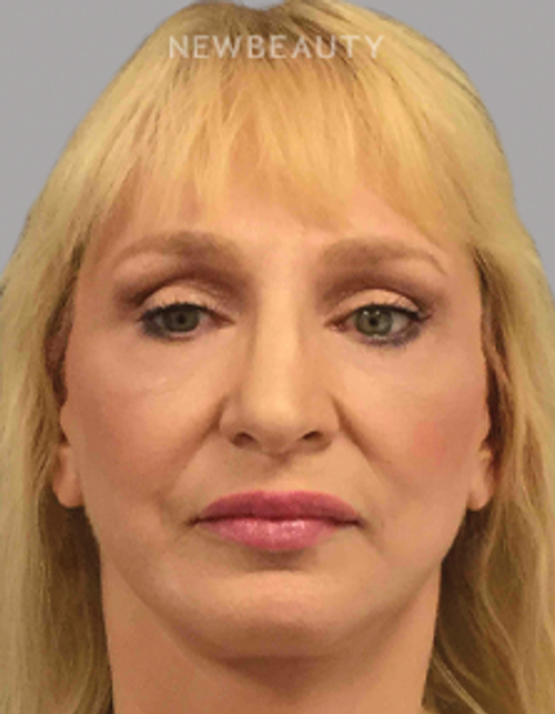 DR. AMY M. SPROLE - Facial Rejuvenation - 46920209 - After